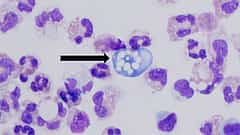 ಮೆದುಳು ತಿನ್ನುವ ಅಮೀಬಾ ಅಥವಾ Amebic Meningo encephalitis (ಕುಶಲವೇ ಕ್ಷೇಮವೇ)
